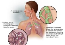 Inhalation Anthrax