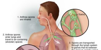 Inhalation Anthrax