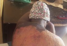 Photo of the victims showing severe burns following the hot water bath.