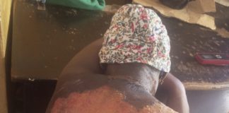 Photo of the victims showing severe burns following the hot water bath.