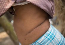 A filed photo of a person whose kidney was removed.